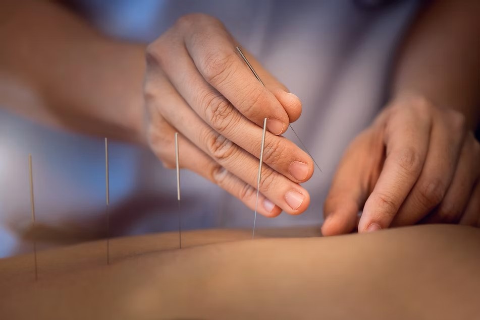 Acupuncture